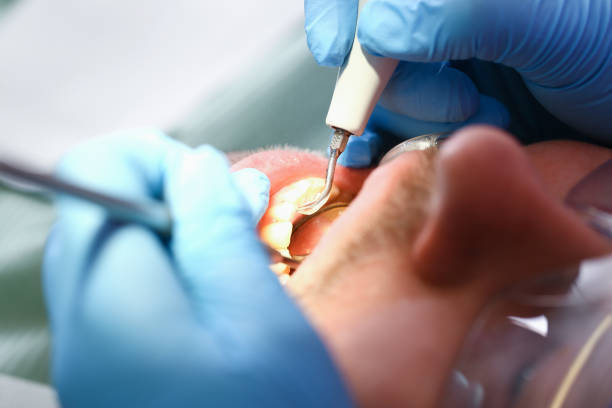 Best Emergency Wisdom Tooth Extraction in Florin, CA