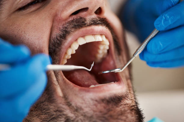 Best Emergency Wisdom Tooth Extraction in Florin, CA