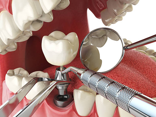 Best Emergency Root Canal Therapy in Florin, CA
